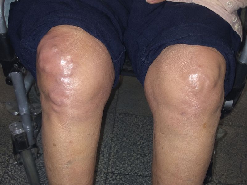 Dolor articular de Doña Carmen