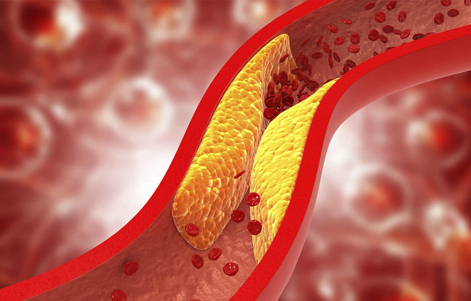 Arteria ostruita dal grasso